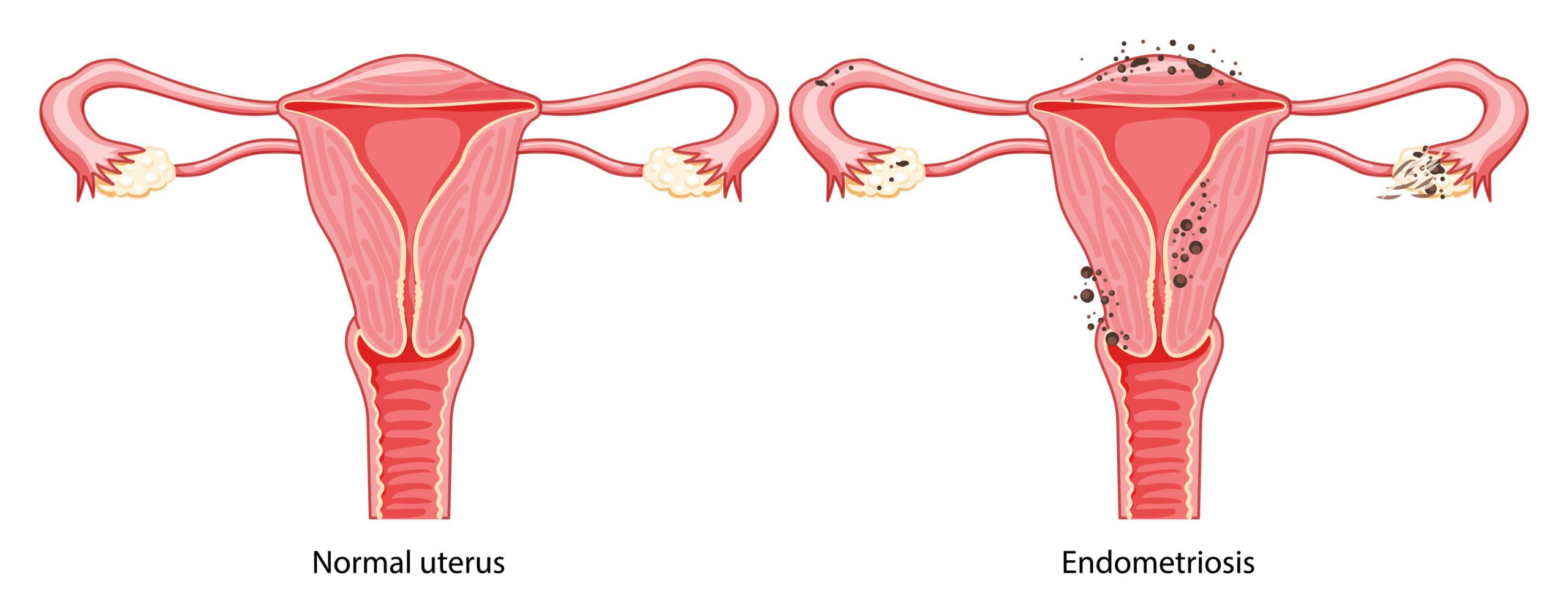 Endometriosis Diagram